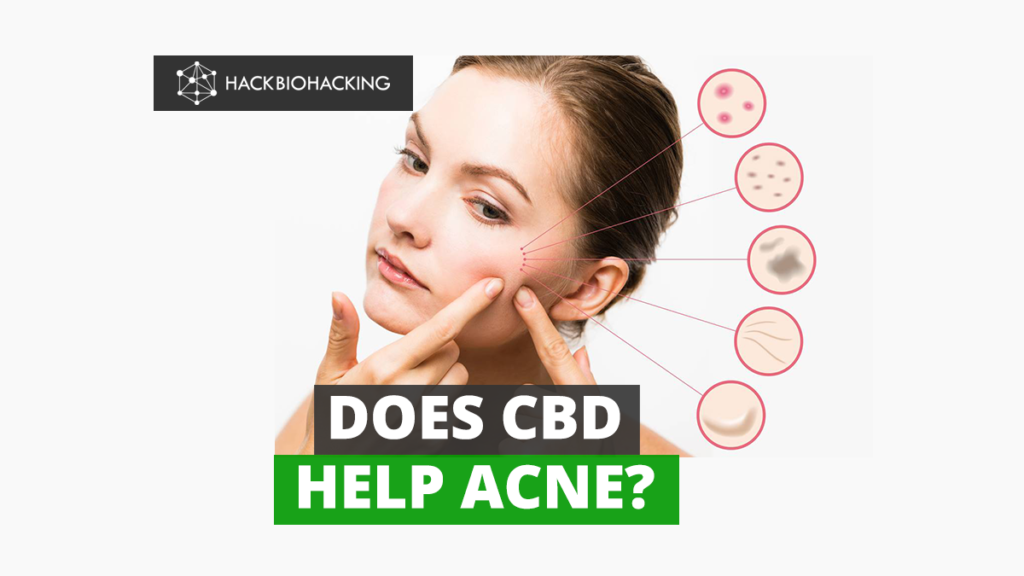 CBD | CBD Acne | Acne